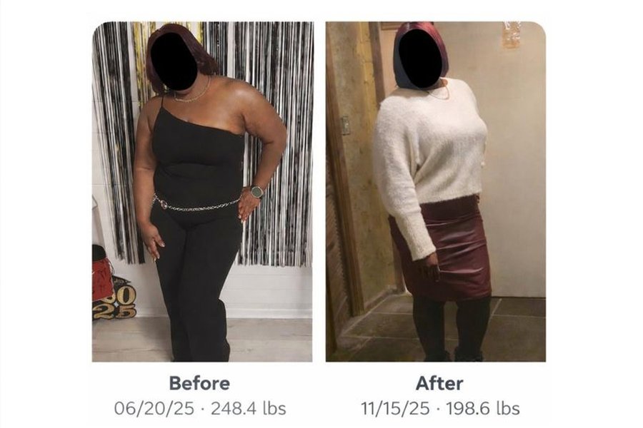 Before and after patient story 4
